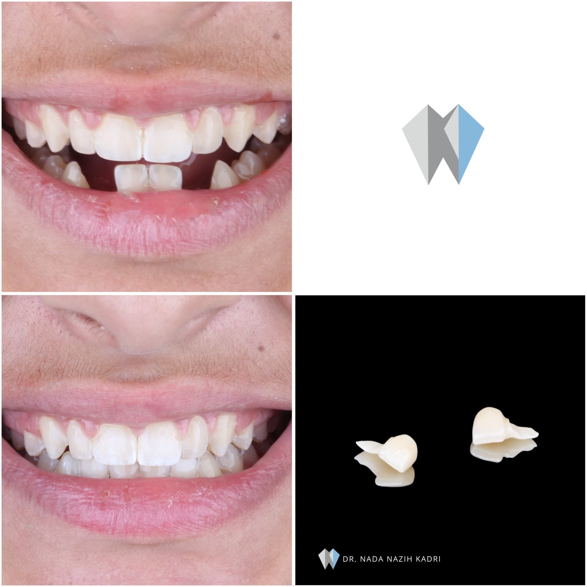 Before and after dental restoration showing the replacement of missing teeth with natural-looking bridges.