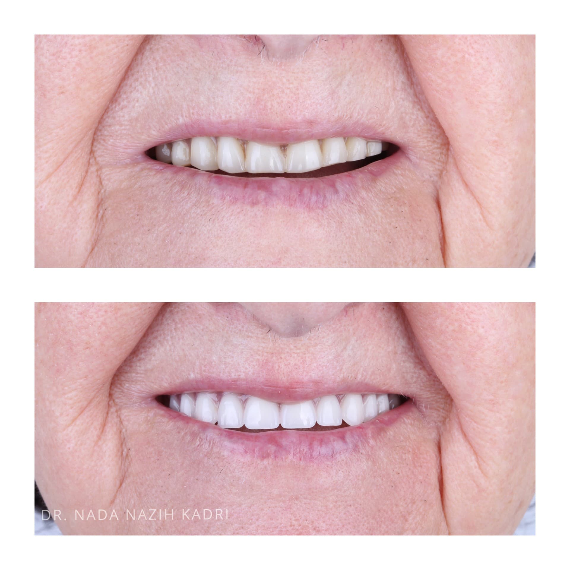 Before and after dental transformation showing yellowed teeth versus bright white, perfectly aligned veneers.
