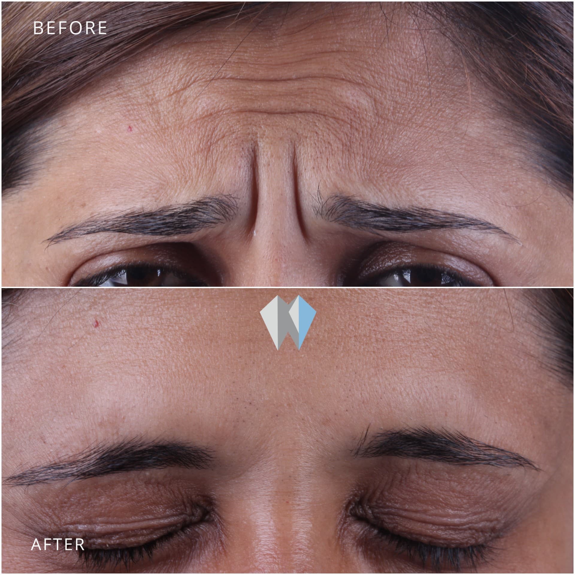 Before and after comparison showing a significant reduction in deep forehead wrinkles and frown lines.