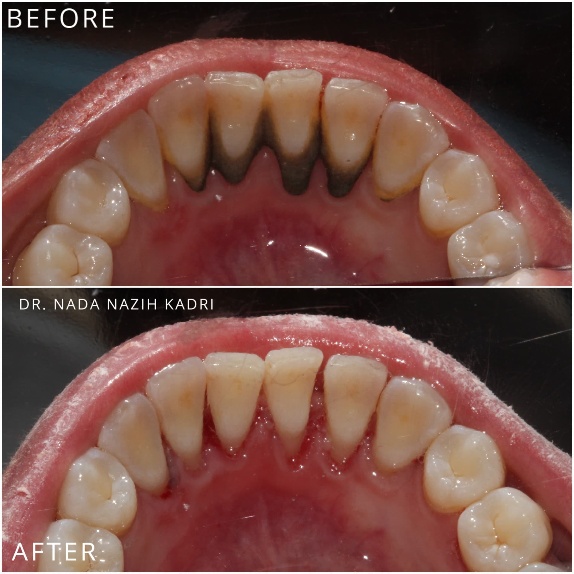 Before and after dental cleaning showing removal of significant dark tartar buildup on lower teeth.