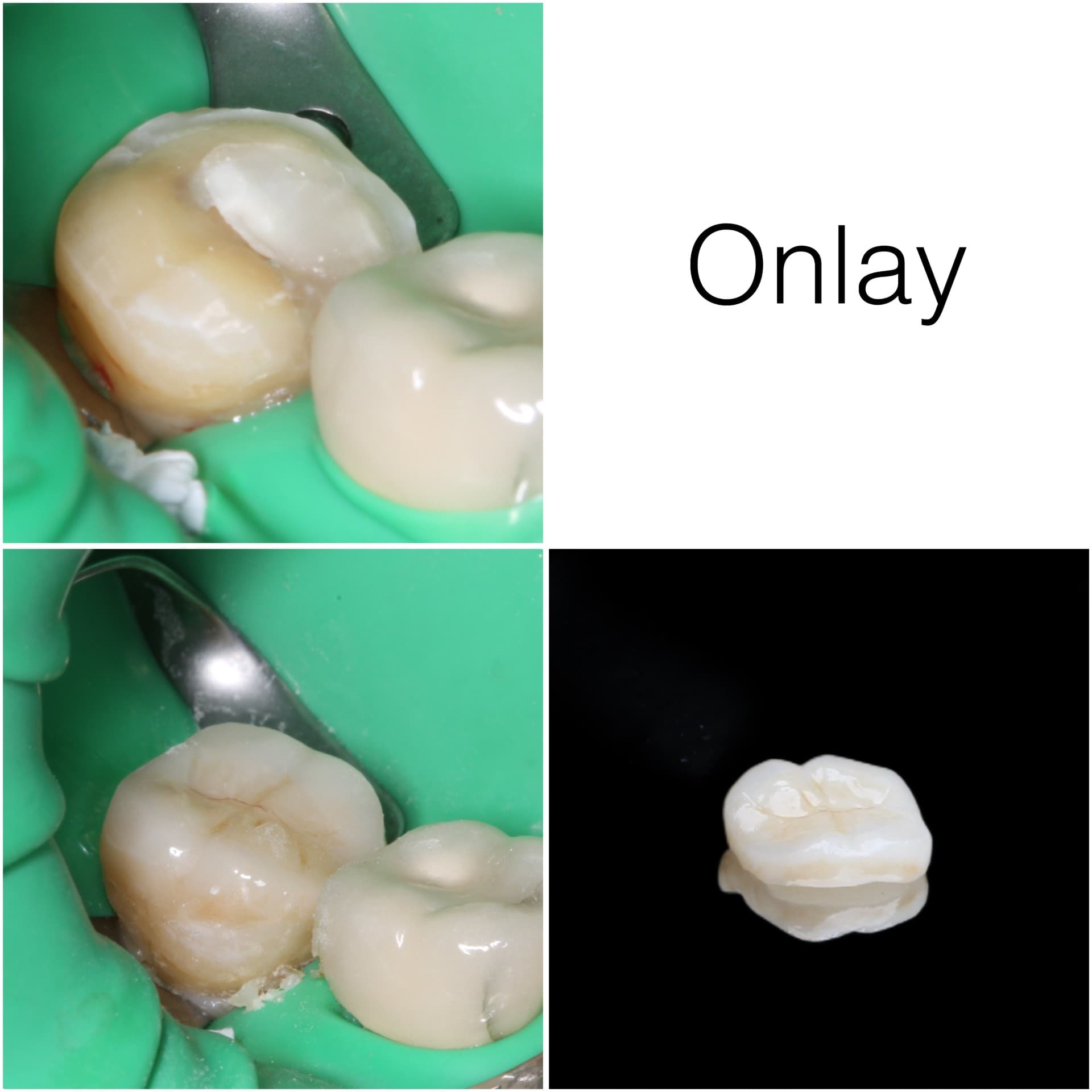 Collage illustrating a dental onlay procedure from tooth preparation to final ceramic restoration placement.