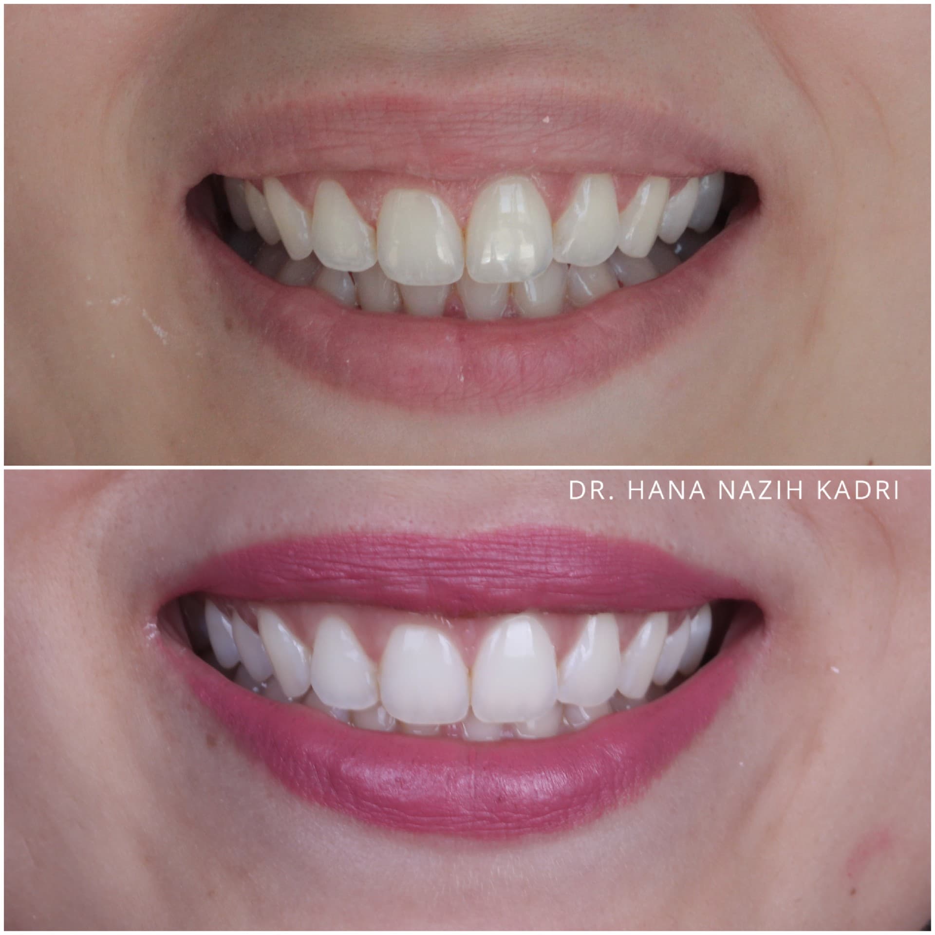 Before and after dental transformation showing whiter, more uniform teeth and a reduced gummy smile.