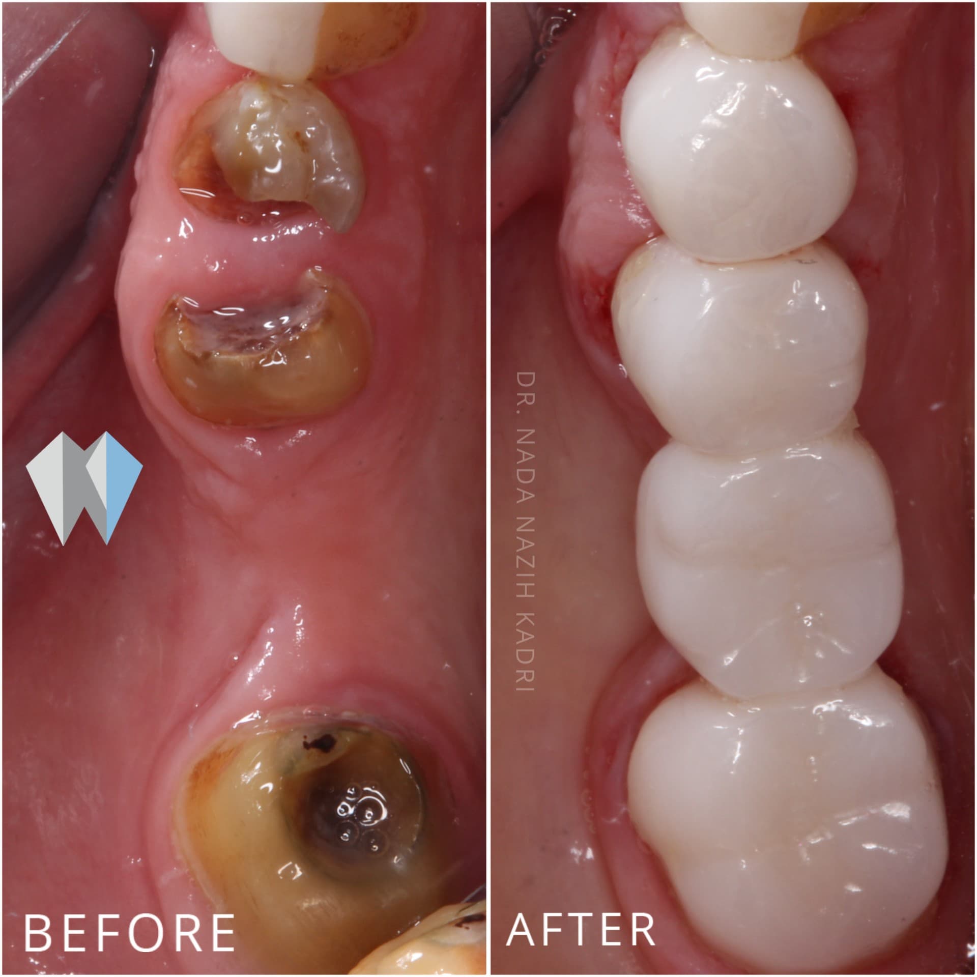 Before and after comparison of severely decayed teeth restored with clean white dental crowns.