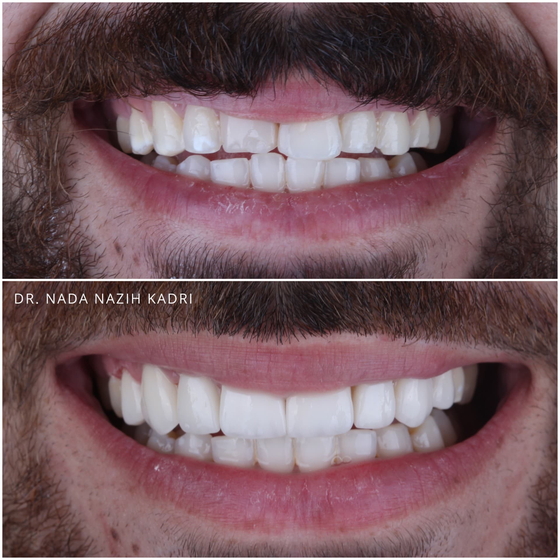 Before and after comparison of a man's smile showing a professional cosmetic dental transformation.