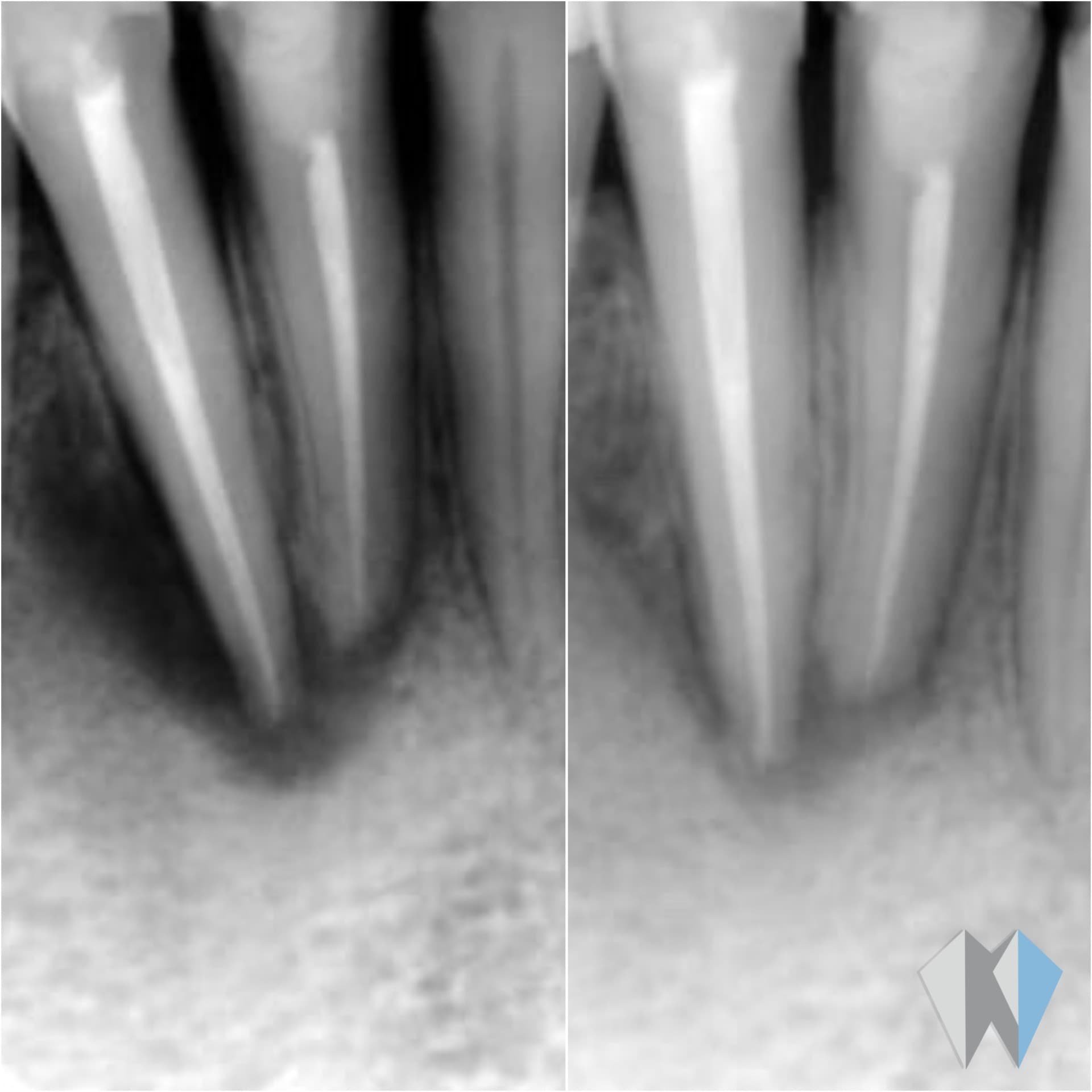 Before and after dental X-rays demonstrating bone regeneration following successful root canal treatment.