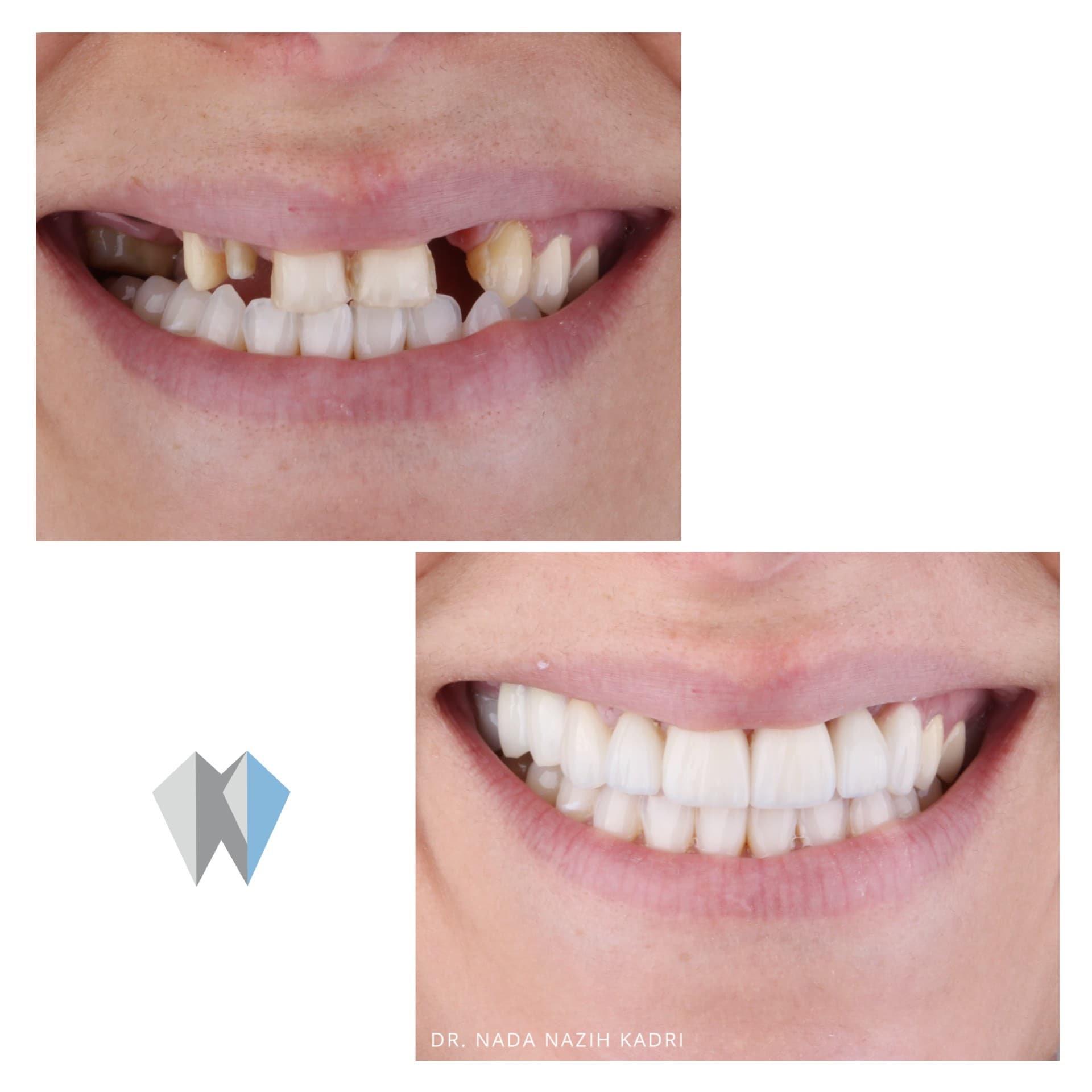 Before and after dental restoration replacing missing teeth with a full set of white veneers.