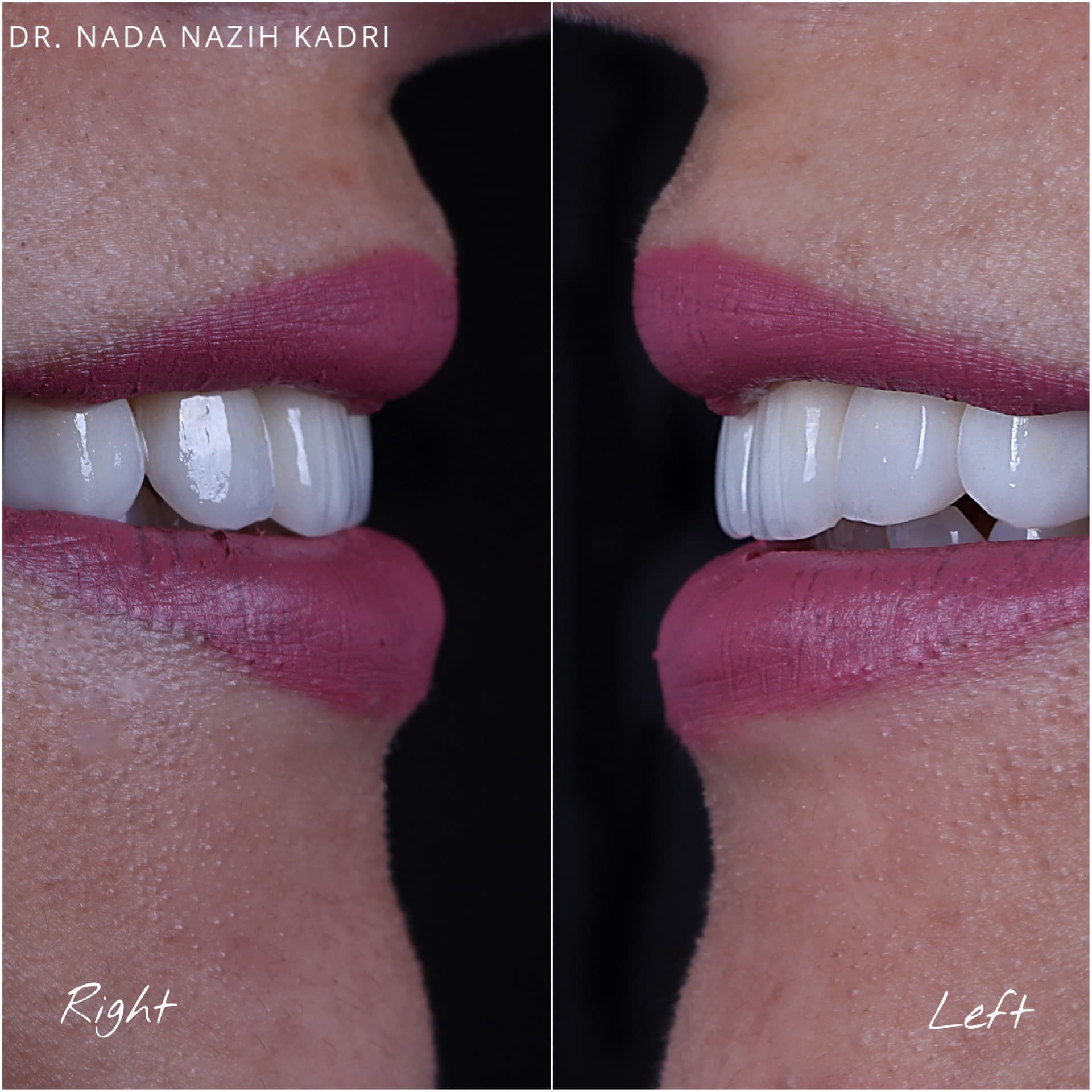 Side-by-side profile views of a smile with bright white dental veneers and pink lipstick.