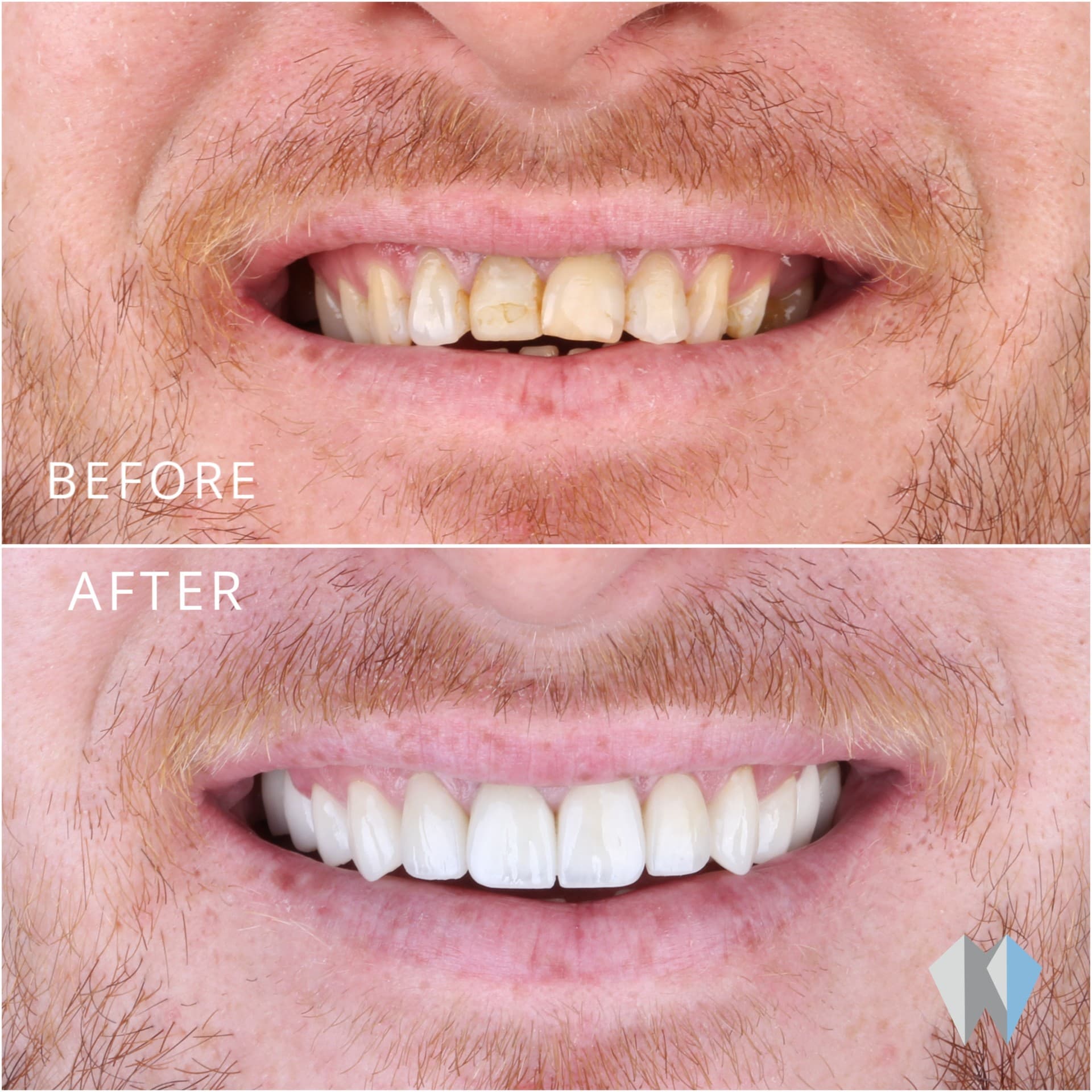 Before and after comparison showing yellowed, uneven teeth transformed into a bright, straight white smile.