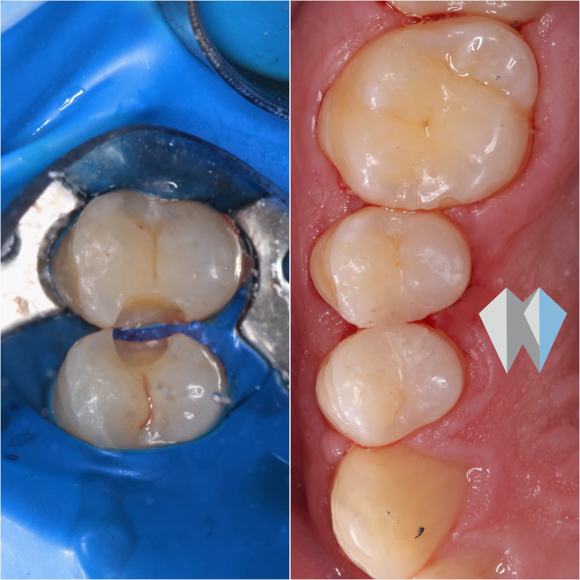 Before and after comparison of dental cavity preparation and finished natural-looking composite resin fillings.
