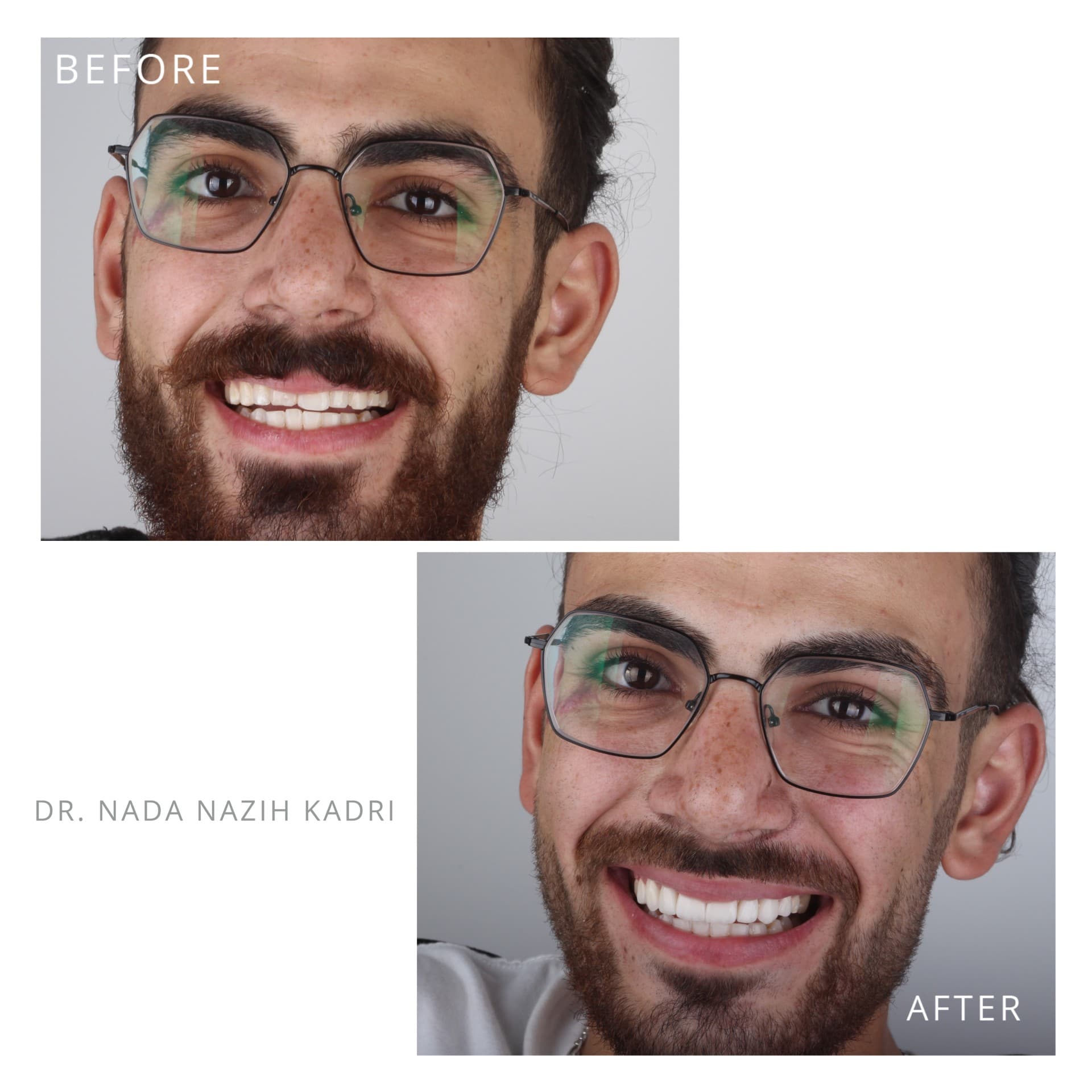 Before and after photos of a man's smile transformation with whiter and straighter teeth.